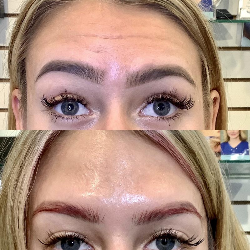 botox, Botox &#038; Dysport in Calabasas, CA