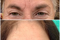 botox-ba-18