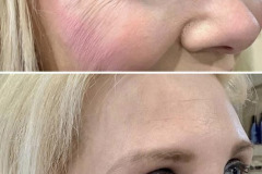 botox-ba-19