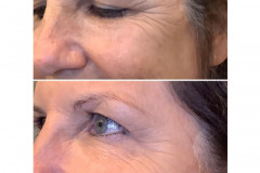 botox-ba-20