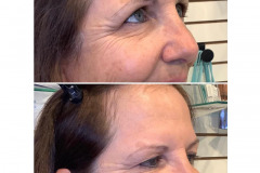 botox-ba-21