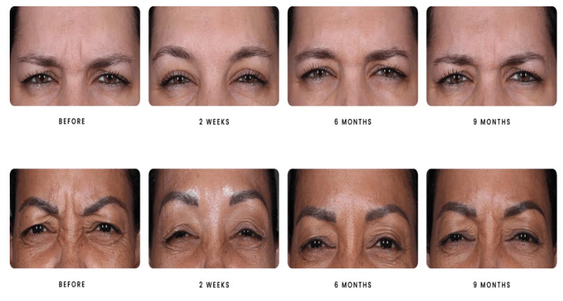 botox, Botox &#038; Dysport in Calabasas, CA